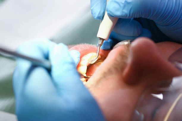 Best Emergency Tooth Extraction in Dickinson, ND